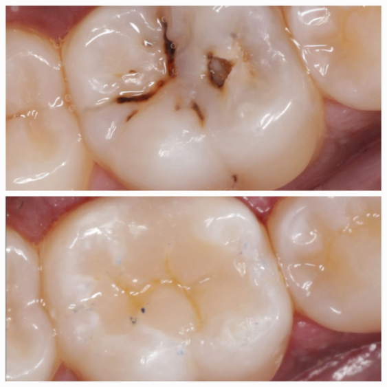 Painless Tooth Extraction in Indore Mahalaxmi Nagar 