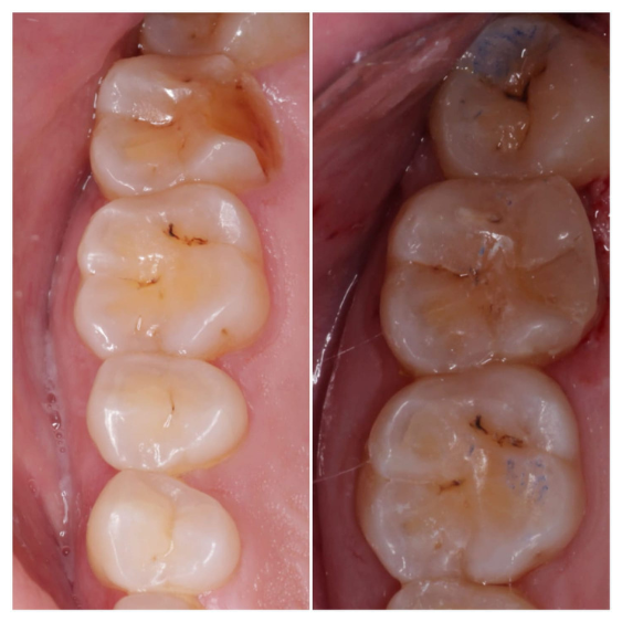 Painless Tooth Extraction in Indore Mahalaxmi Nagar 