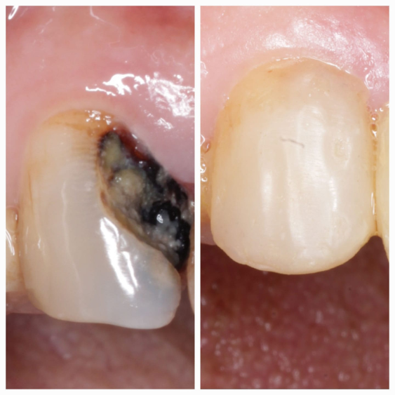 Painless Tooth Extraction in Indore Mahalaxmi Nagar 