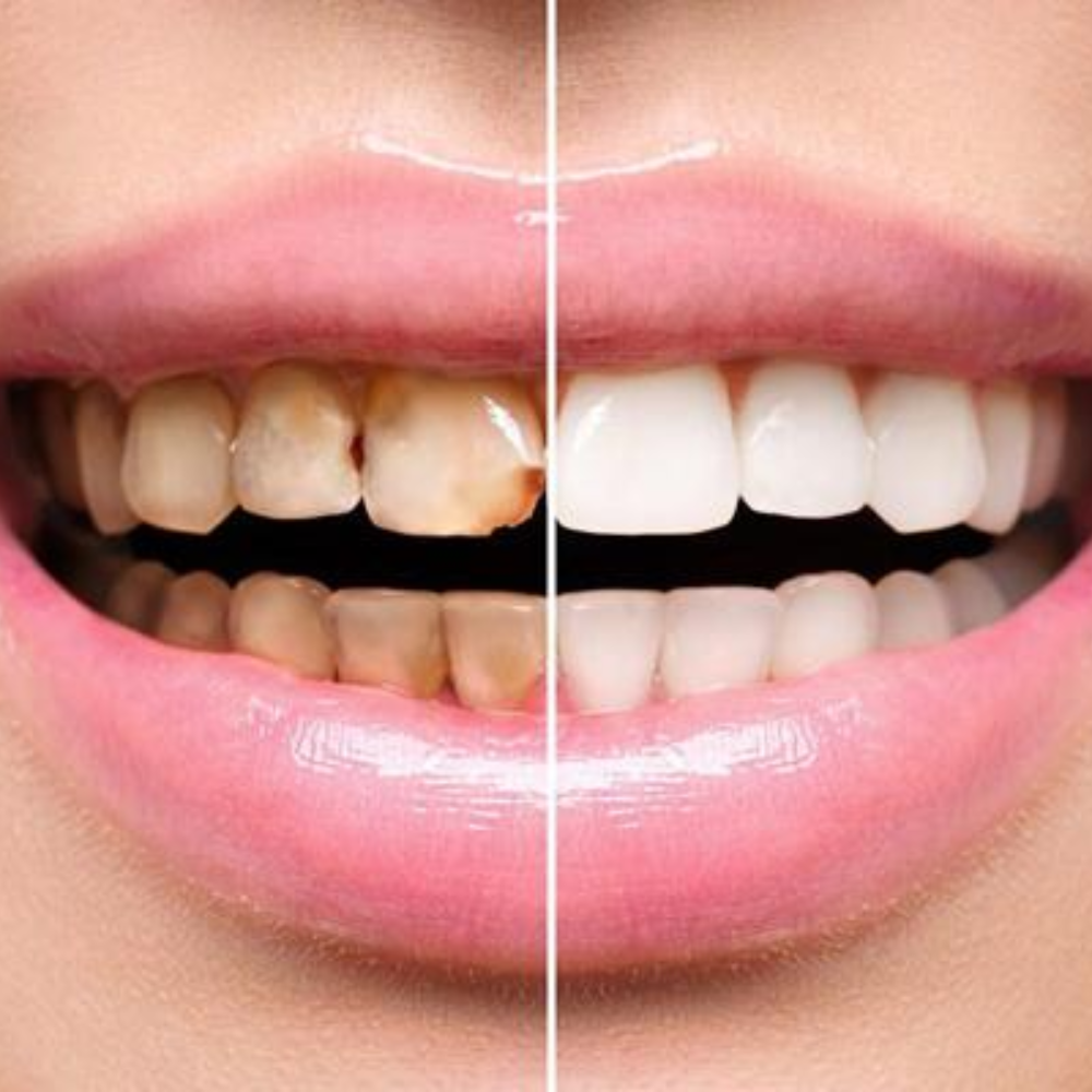 Root Canal Specialist in Mahalaxmi Nagar Indore